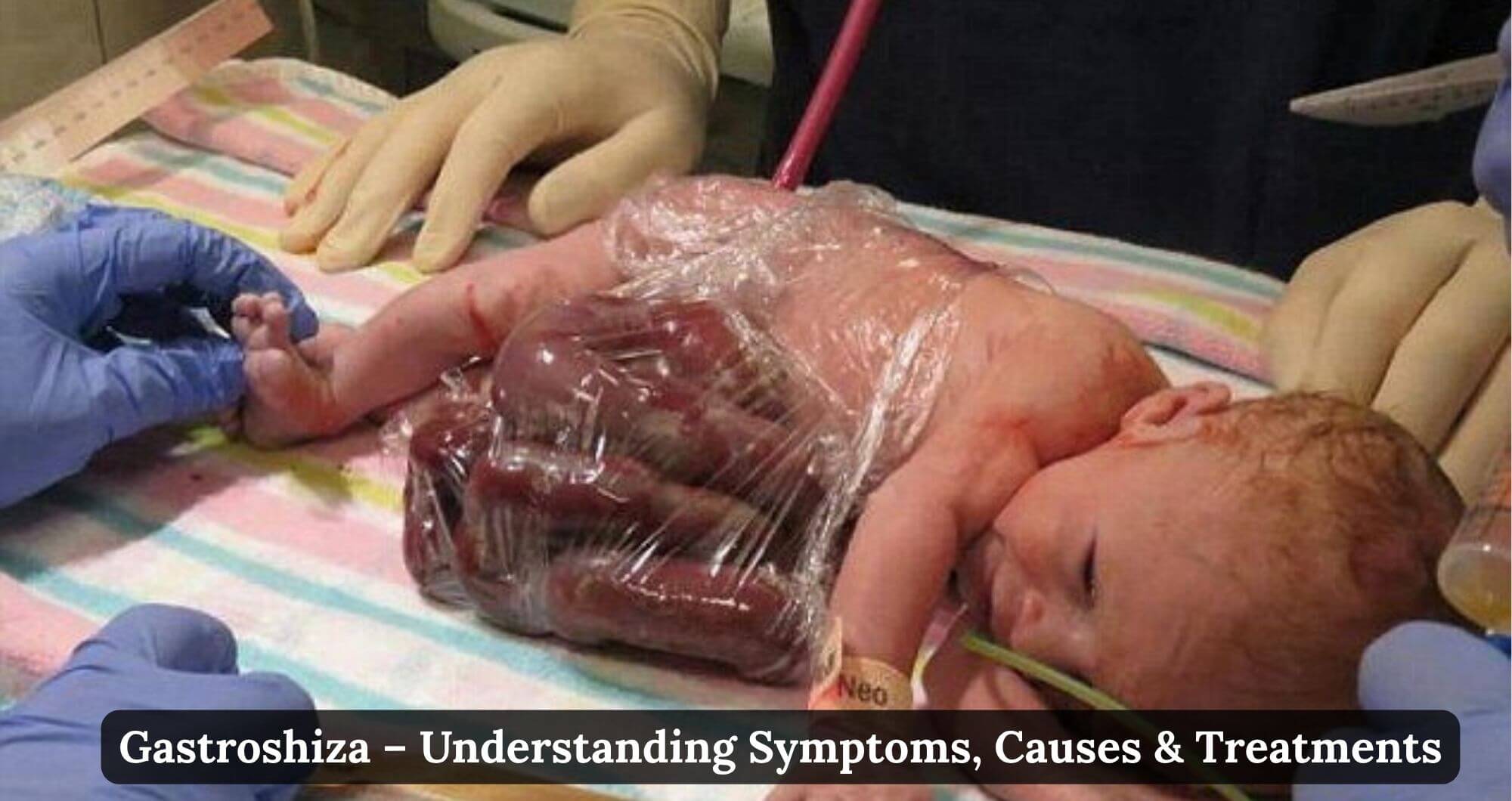 gastroschisis