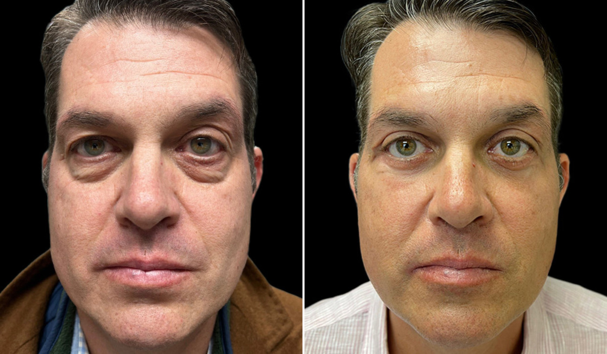 Is Blepharoplasty in Dubai the Right Choice for You?