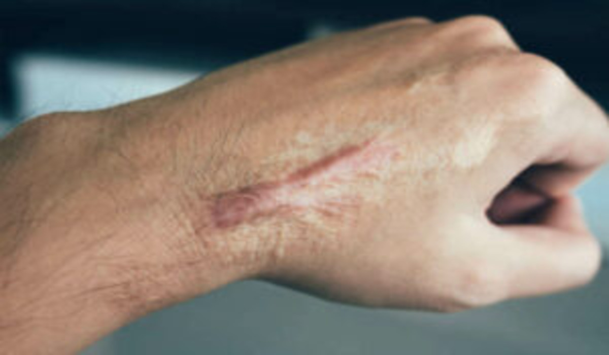 Understanding Keloids