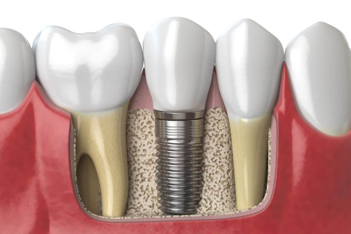 Implant Dentistry