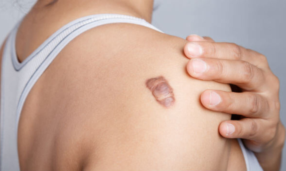 Keloid