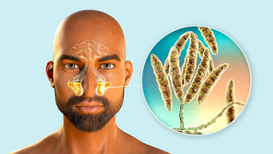 Feeding Your Allergic Fungal Sinusitis